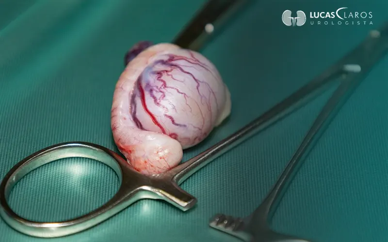 Cirurgia para varicocele: quando é indicada e como funciona o pós-operatório