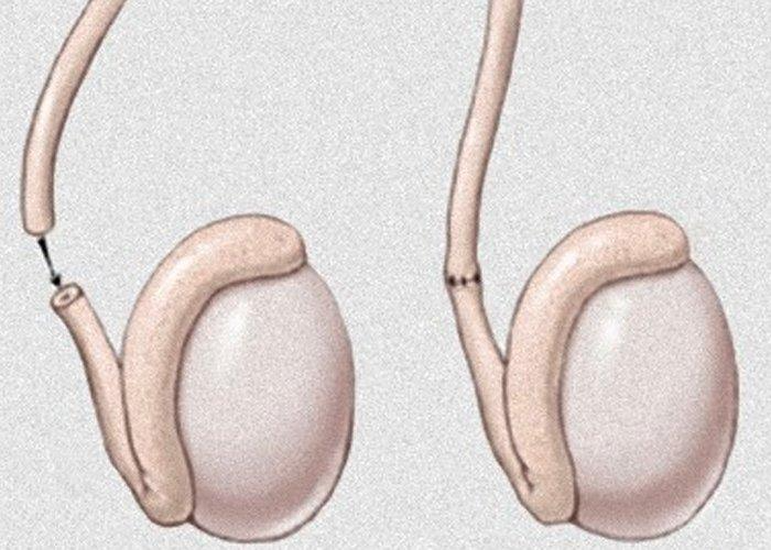 Reversão de vasectomia: é possível recuperar a fertilidade? Veja o que diz a medicina 